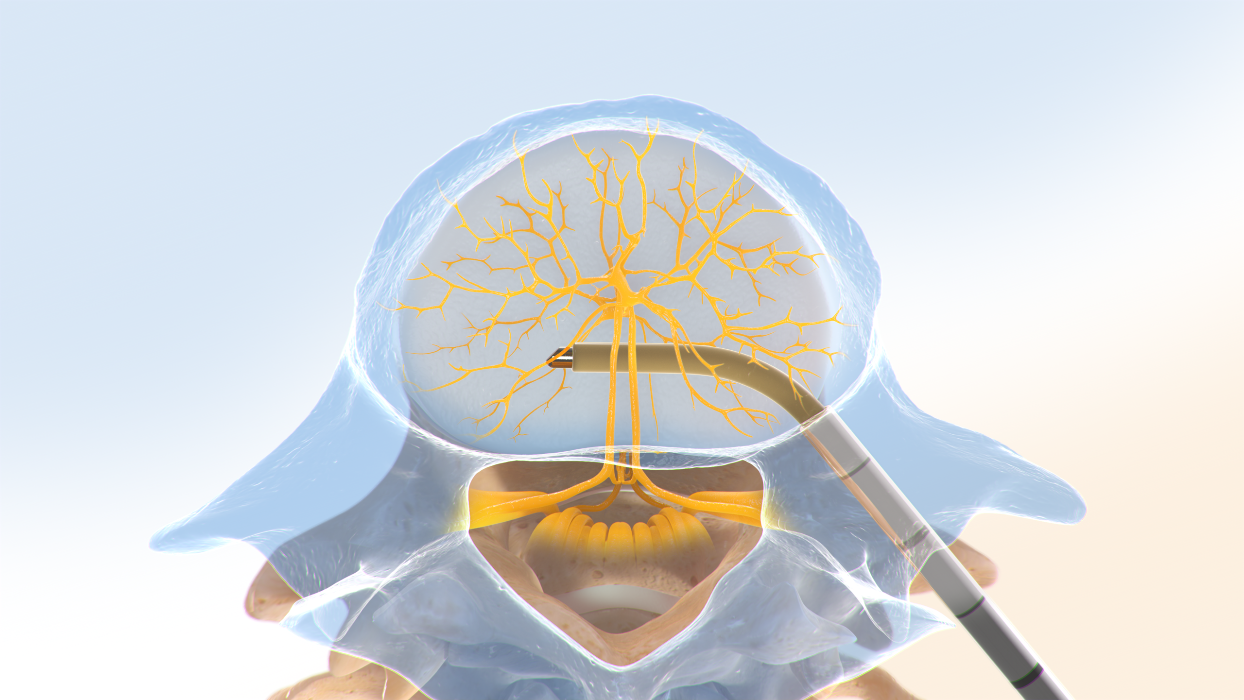 Intracept Procedure step 2 illustration