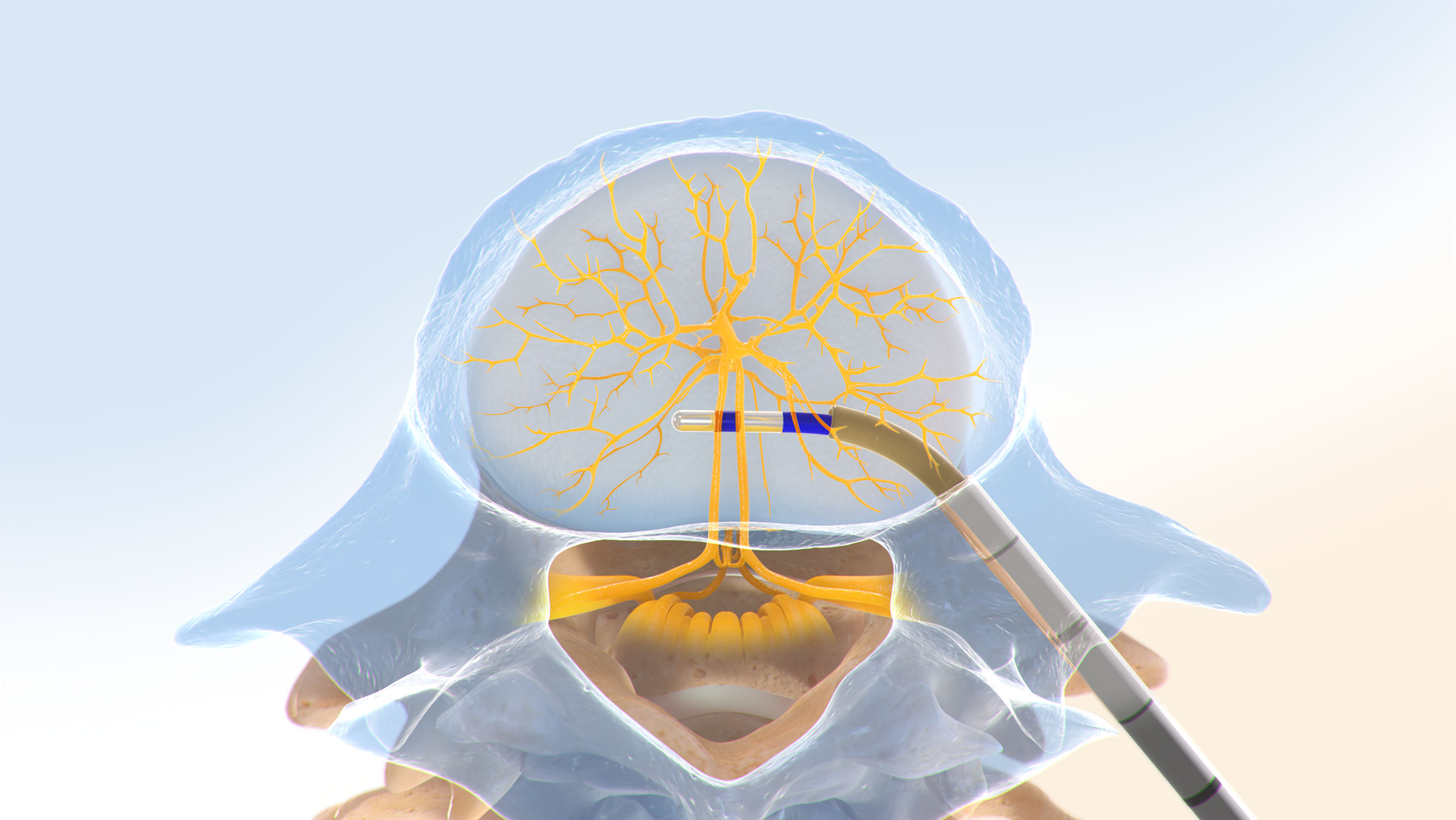 Intracept Procedure step 3 illustration
