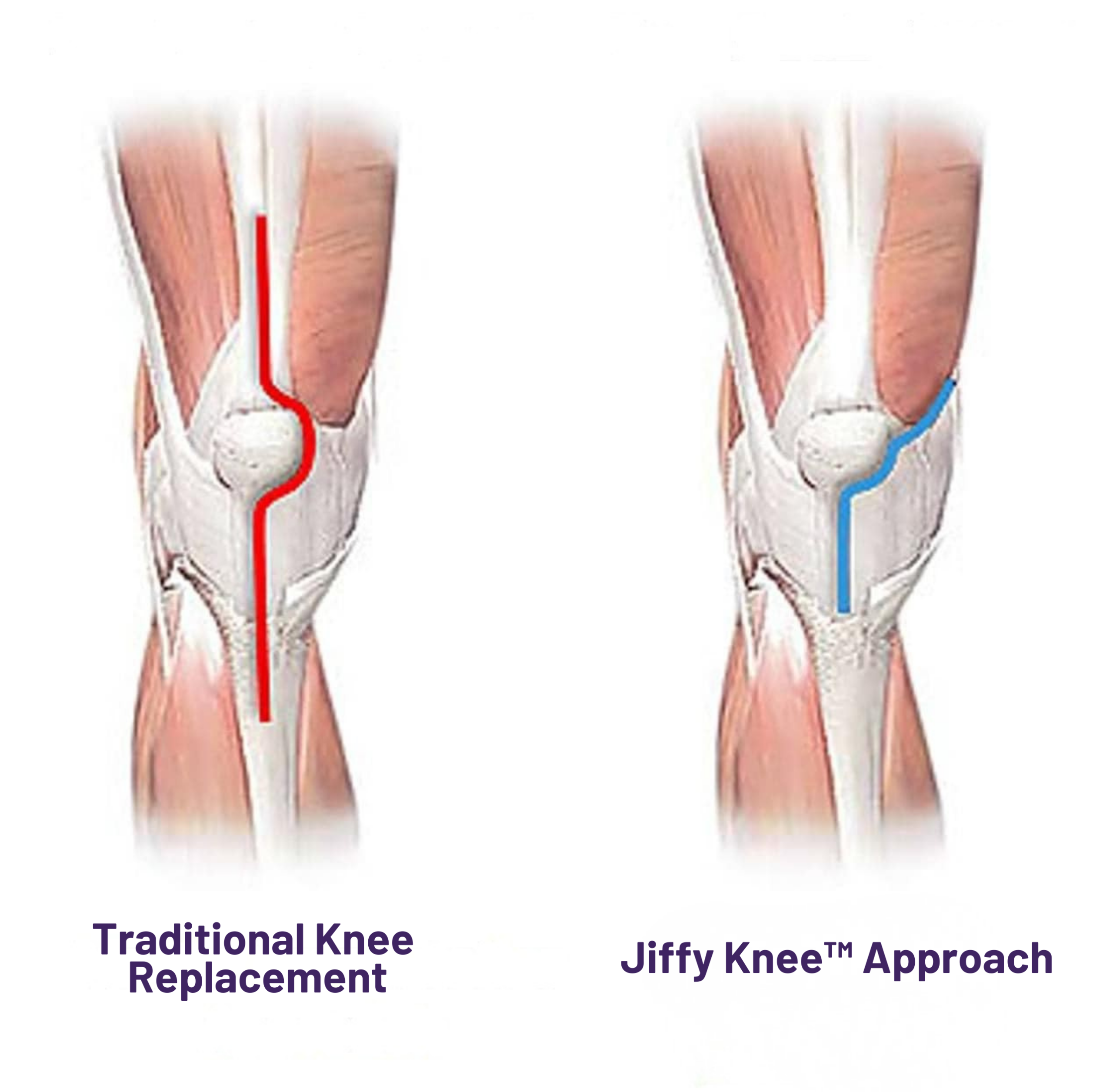 Traditional knee replacement vs Jiffy Knee approach